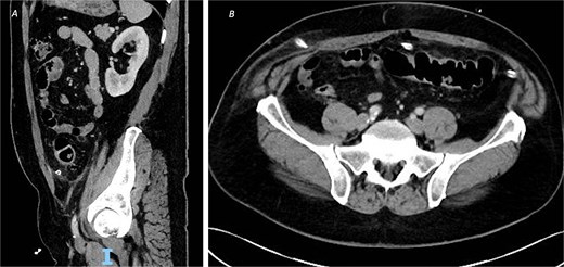 CT of the abdomen and pelvic with contrast on post-operative Day 8 demonstrating resolution of the inflammatory changes with no evidence of leak or abscess formation, from (A) sagittal view and (B) axial view.