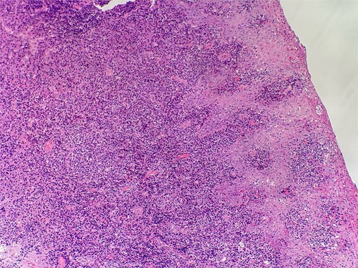 Slide from epiglottis specimen at index presentation showing squamous mucosa and underlying polyclonal plasmocytic infiltrate.