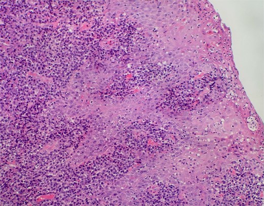Slide from index presentation under higher magnification again demonstrating plasmocytic infiltration.