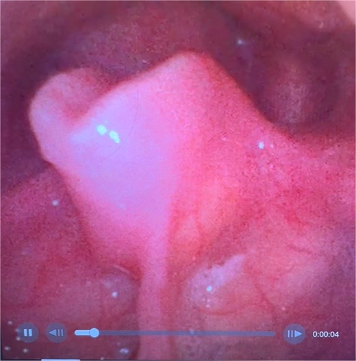 Flexible endoscopic view of a retroflexed epiglottis with a fixed, stenotic appearance of the supraglottic airway.