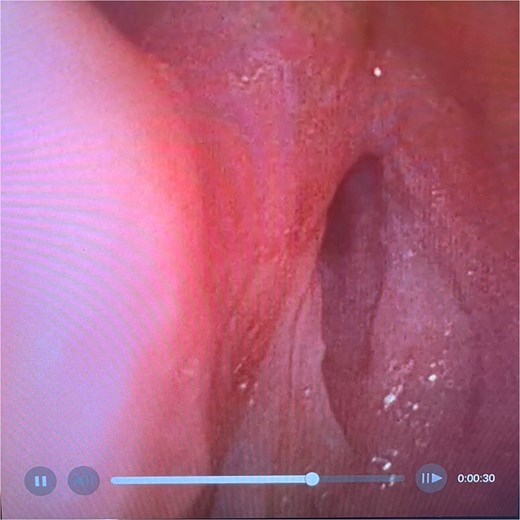Flexible endoscopic view of best image achieved of glottic airway demonstrating severe stenosis and slit-like airway with minimal mucosal oedema.