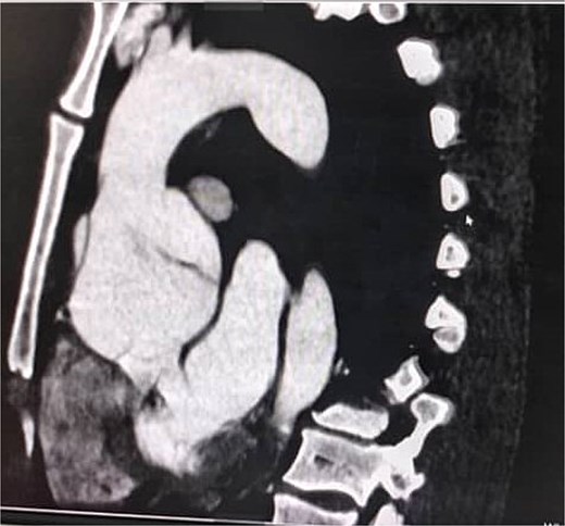 Coronal CT angiography showing a chronic dissecting aneurysm of the ascending aorta.