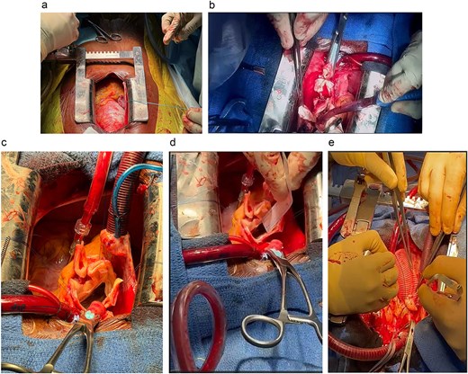 Modified Tyrone David procedure using the El Arid–Modine technique. (a) Intraoperative view showing dilatation of the aortic root, confirming the preoperative diagnosis and justifying the indication for the Tyrone David valve-sparing technique. (b) Excision of the Valsalva sinuses: Resection of diseased aortic tissue while preserving the valve commissures and isolating the right and left coronary ostia. (c) Suspension of the aortic valve commissures prior to measuring commissural heights. (d) Measurement of commissural height to determine the appropriate size of the Dacron graft (30 mm). (e) Reimplantation of the coronary arteries into the vascular graft following implantation.
