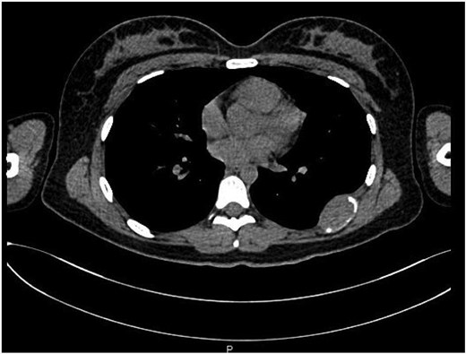 Transverse view of the lesion located on the seventh rib.