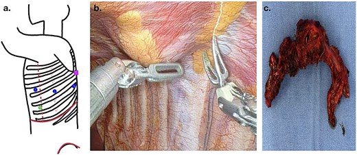 (a) Port placement for RATS access: the most inferior and anterior dot (green dot) indicates the camera port, the dots located at the middle of the scheme (blue) represent the robotic arm ports, and the most posterior and superior dot (pink) designates the area where the tumor was located; (b) robotic view of dissection; (c) surgical specimen extracted.