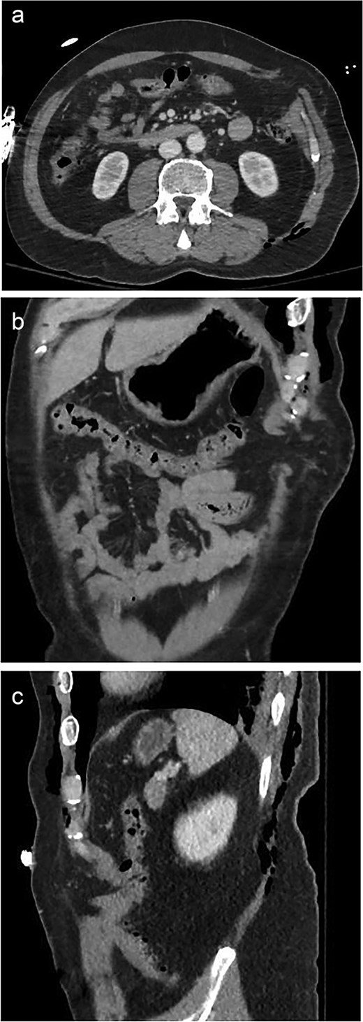 A 59-year-old male with a traumatic Spigelian hernia seen on CT. (a) Axial, (b) coronal, and (c) sagittal views of the hernia.
