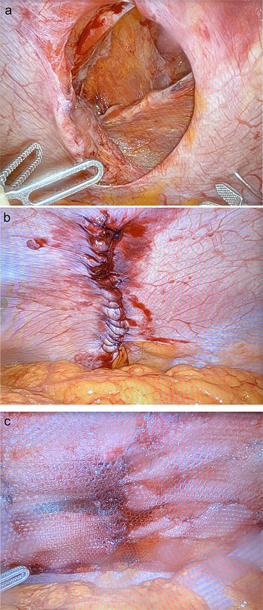 Intraoperative images of the hernia (a) prior to repair, (b) after primary closure, and (c) with onlay composite mesh placement.