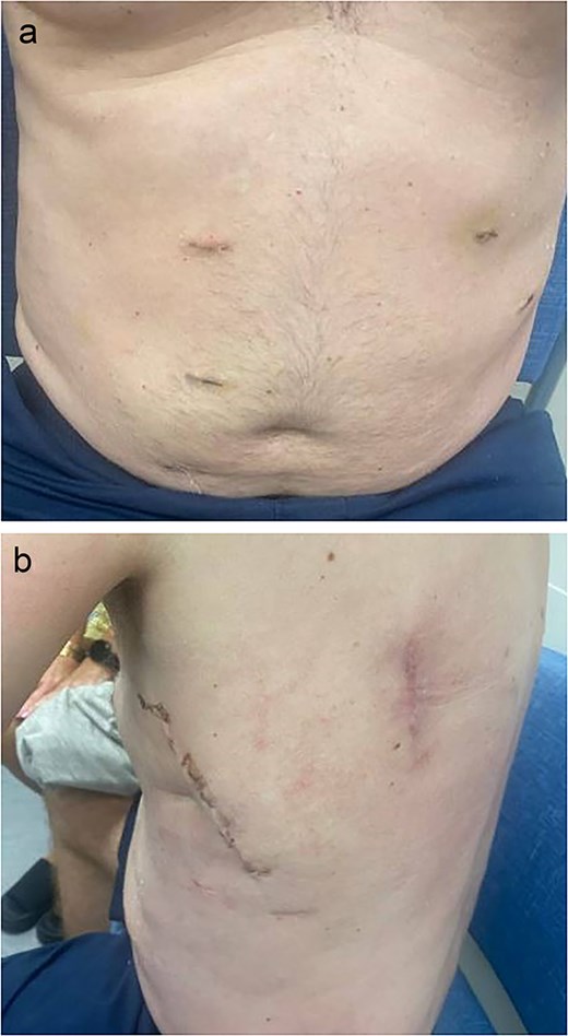 Postoperative images at 1 month follow-up with (a) frontal and (b) lateral views.