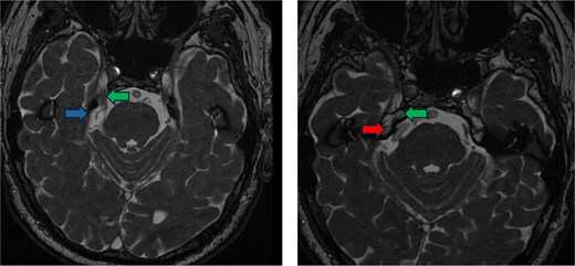 Preoperative imaging. FIESTA scan demonstrating the compression of the trigeminal nerve (green arrow) by the vertebral artery (red arrow) inferiorly and the superior cerebellar artery (blue arrow) superiorly.