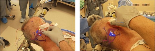 Surgeon’s view through the AR headset of the 3D model registered onto the patient. The model contains vasculature (red), brainstem (blue), and trigeminal nerve (yellow). The surgeon can optimize the head position and plan incision and craniotomy with the view of the registered 3D model.