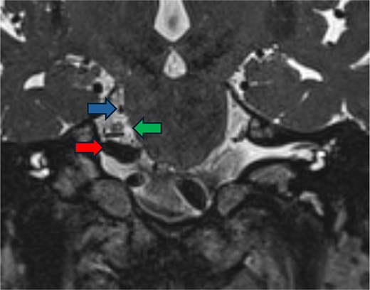 Postoperative imaging. FIESTA scan demonstrating the relief of compression of the trigeminal nerve (green arrow) by the vertebral artery (red arrow) and the superior cerebellar artery (blue arrow).