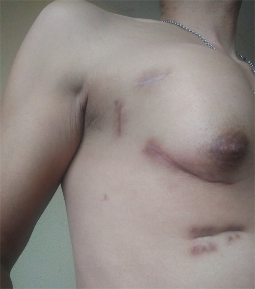 Swelling in the right anterior chest due to a lung hernia.