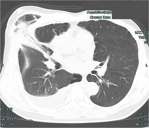 Lung herniation of the right middle lobe at the fourth intercostal space.