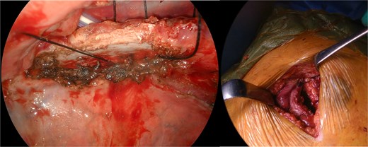 Intraoperative view of rib approximation using nonabsorbable sutures.