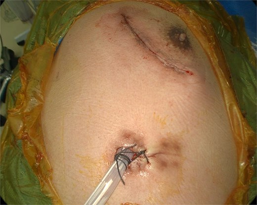 Chest drain placed through the port incision following the repair.