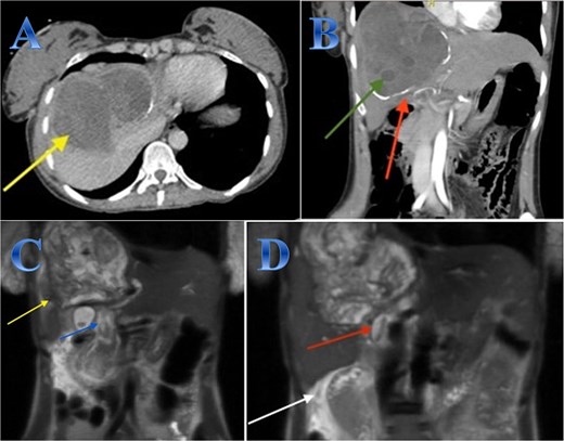 Case 1. (A & B) Sagittal and coronal CT cuts of the abdomen at venous phase showing a large peripherally calcified heterogeneous hypodense mass in the right hepatic lobe (photo A), with internal septations and small cysts (daughter cysts), with dilated IHBRs (photo B). (C & D) Coronal MRI images of the abdomen (follow up study) showing biliary extension of the lesion, CBD and the hepatic duct and sub hepatic fluid signal.