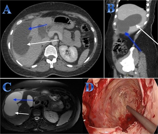 Case 2. (A & B) Sagittal and axial CT cuts of the abdomen at venous phase showing right hepatic intra-parenchymal cystic lesion with subcapsular extension with no obvious post contrast enhancement. (C) MRI images showing right hepatic intra-parenchymal cystic lesion with subcapsular extension, proven to be sealed perforation. (D) The intraoperative finding after laparoscopic endocystectomy and the area of the cyst which was occupying the right hemi-liver under the ribs and reaching the diaphragm.