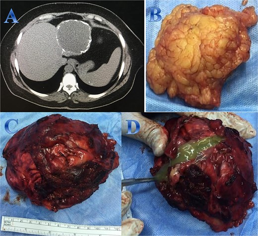 Case 3. (A) Coronal CT cut of the abdomen at venous phase showing a well-defined cystic lesion (hydatid cyst) seen at the left hepatic lobe, showing calcifications, the lesion seen partially exophytic from the liver and abutting the lesser curvature of the stomach. (B & C) The hydatid cysts that were resected from the liver (C) and from the greater Omentum (B). (D) After resection the liver hydatid cyst was opened to examine the content of the cyst which is showing jelly like structure.