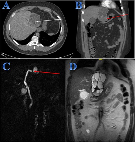 Case 4. (A & B) Post-contrast CT cuts showing well-defined cystic lesion showing internal daughter cysts noted at the left hepatic lobe and seen exophytic indenting the lesser curvature of the stomach, septate lesion is seen in the left lobe of the liver (photo A). The lesion is abutting the lesser curvature of the stomach with intact fat planes between the two (photo A). (C & D) MRI cuts showing well-defined, septate lesion, abutting the lesser curvature of the stomach. The lesion makes some mass effect off the left hepatic biliary radicles communicating with the lesion (photo C).