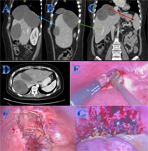 Case 5. (A, B, C & D) Three large hepatic cystic lesions seen, the largest two lesions seen at the hepatic dome and right hepatic lobe seen non-separable from each other, showing peripheral coarse calcifications (photo A), the lesions seen abutting and exerting mass effect on the intrahepatic IVC (photo D). One lesion seen exophytic superiorly to the subdiaphragmatic region elevating the right hemidiaphragm (photo C), the second lesion exophytic inferior posteriorly (photo B). (E) The content of the cyst in liver segment 8 after opening the cyst and aspiration. (F) Area of liver segment 4 after complete resection of the cyst after cholecystectomy. (G) Area above tow cysts in liver segment 7 & 8 after complete separation from diaphragm and resection of the cysts.