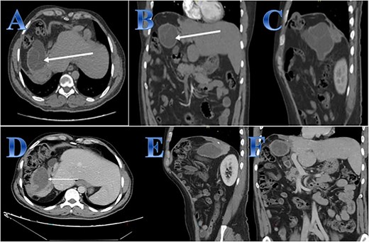 Case 6. (A, B & C) Before treatment; residual small part of right hepatic lobe is seen with irregular borders and calcifications (post-operative changes) evidence of well-defined cystic lesion seen related to the anatomical site of the resected right hepatic lobe with internal septations that showed faint septal post contrast enhancement. (D, E, F) After treatment; regressive course of previously reported cystic lesion. Interval regressive course of the previously seen well defined cystic lesion seen at right hepatic lobe measuring 6 × 4.4 × 5 cm while previously measuring 88 × 65 × 82 mm at AP, transverse, and vertical dimensions respectively.