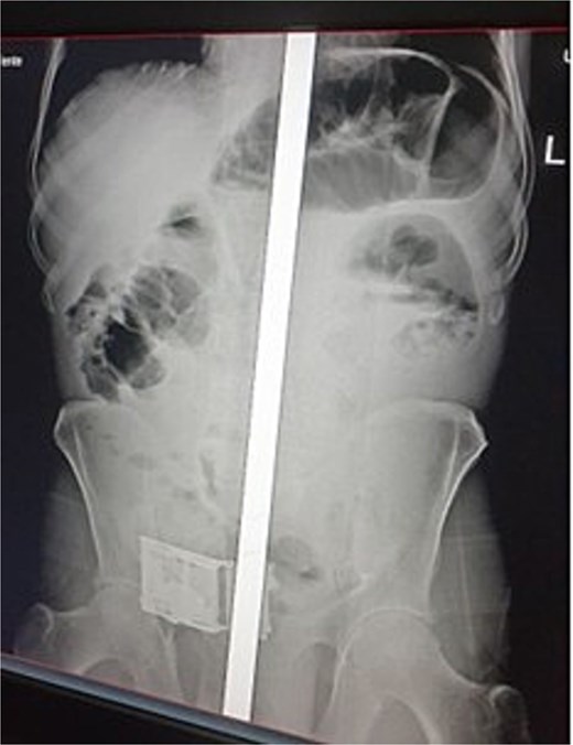 Abdominal radiograph showing multiple distended loops of small bowel.