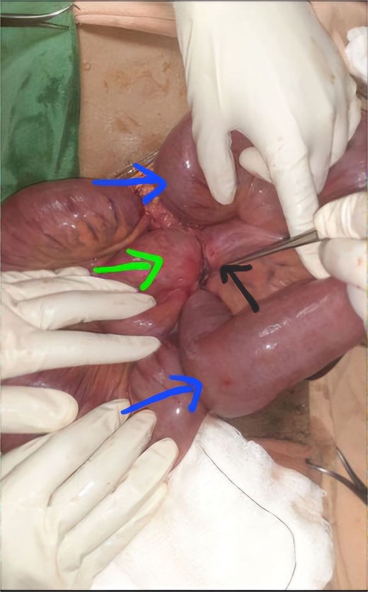 The appendix (black arrow) encircling the loops of terminal ileum (green arrow) with dilatation of proximal bowel loops (blue arrows).