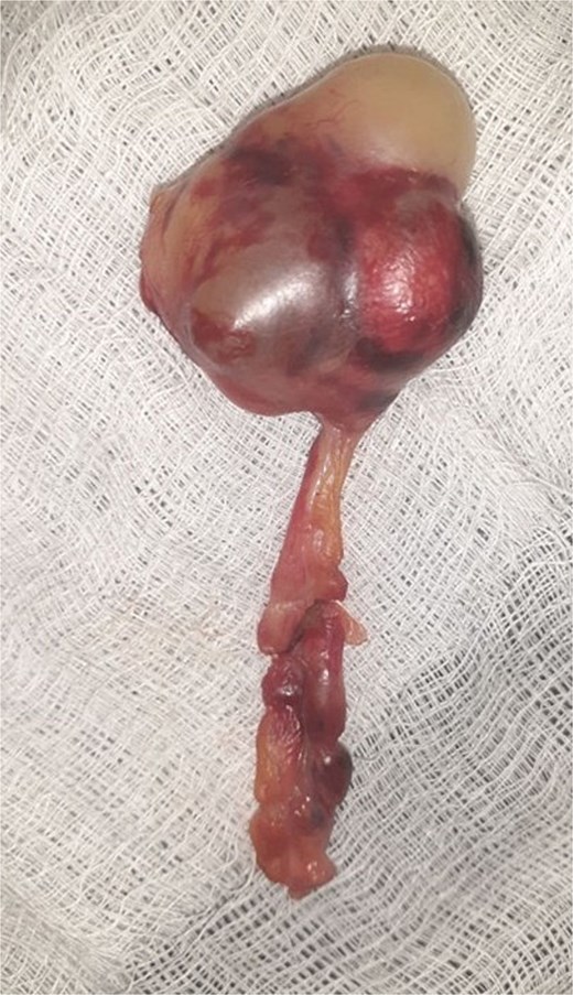Showing the appendix with multiple cystic mass.