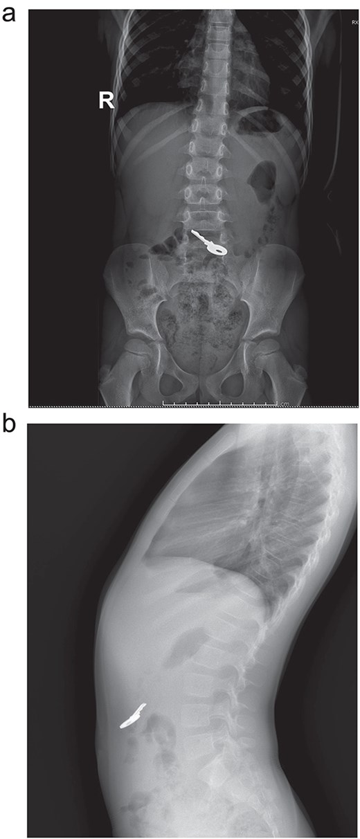 (a) X-ray: A full key is seen ingested, no pneumoperitoneum or signs of obstruction. (b) X-ray: the key is seen in the intestine.