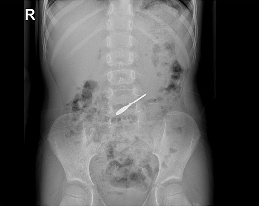 X-ray: the key is seen moving and changing position.