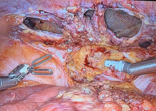 Recurrence on postoperative day 4 image showing multiple defects in the peritoneal closure.