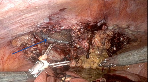 Recurrence on post-operative day 24 showing a significant peritoneal defect on the left side.
