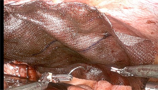Repair with use of Ventralex ST mesh 10 × 8 in as intraperitoneal onlay fashion.