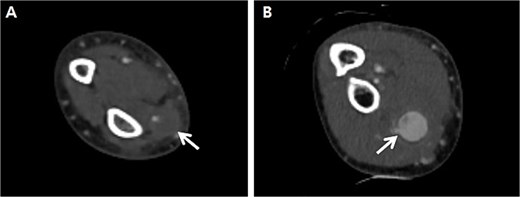 Preprocedural computed tomography of the right upper extremity. (A) Pseudoaneurysm at the distal radial artery which was arterial catheterization site (arrow); (B) Pseudoaneurysm at the proximal radial artery which was not related to arterial catheterization site (arrow).