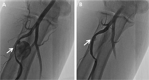 Peripheral angiography of the right upper extremity. (A) Pseudoaneurysm at the proximal radial artery (arrow); (B) Complete occlusion of pseudoaneurysm after covered stent placement (arrow).