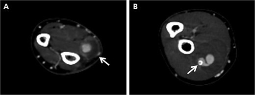 Follow-up computed tomography of the right upper extremity, 2-weeks after the procedure. (A) Pseudoaneurysm at the distal radial artery, size increased from 0.8 cm to 1.5 cm (arrow); (B) Pseudoaneurysm at the proximal radial artery, size increased from 2.0 cm to 4.0 cm with distal migration of covered stent (arrow).