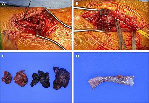 Intraoperative images and pathological specimens after the resection of pseudoaneurysms. (A) Distal lesion which was arterial catheterization site; (B) proximal lesion which was not related to arterial catheterization site; (C) the wall of pseudoaneurysm and hematoma (resected); (D) covered stent (removed).