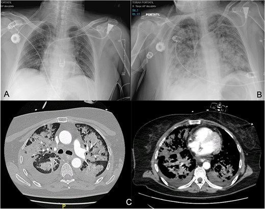 (A, B) Differences between the chest X-ray in the immediate postoperative period and at 36 h after the onset of respiratory failure. (C) The chest CT confirms pulmonary exudates compatible with ARDS (acute respiratory distress syndrome).