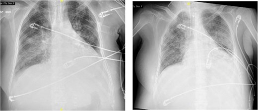 The image on the left shows right basal consolidation and left pleural effusion, which evolves into bilateral interstitial infiltrates in the image on the right.
