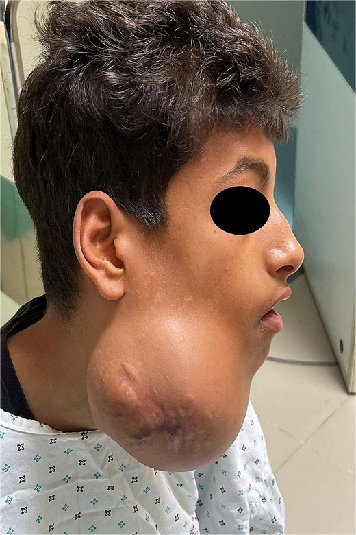 Preoperative lateral view showing the swelling of the right hemiface caused by the mandibular tumour.