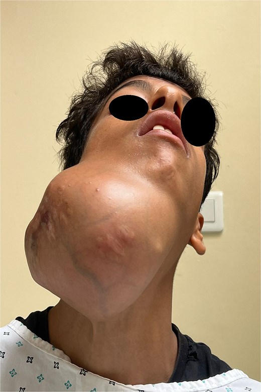 Frontal view illustrating facial asymmetry due to the massive mandibular tumour.