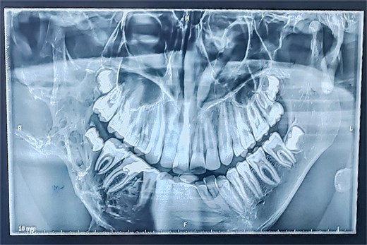 Panoramic radiograph (OPT) revealing an extensive osteolytic lesion of the right hemimandible.