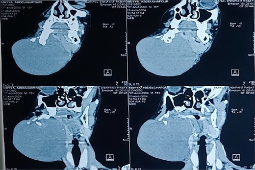Coronal CT scan in soft tissue window demonstrating a well-defined osteolytic mandibular lesion with cortical thinning.
