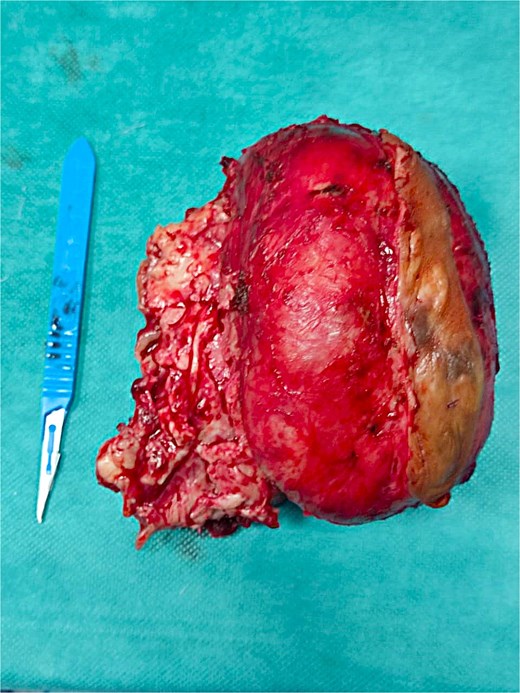 Gross specimen of the resected tumour, displaying its macroscopic features.