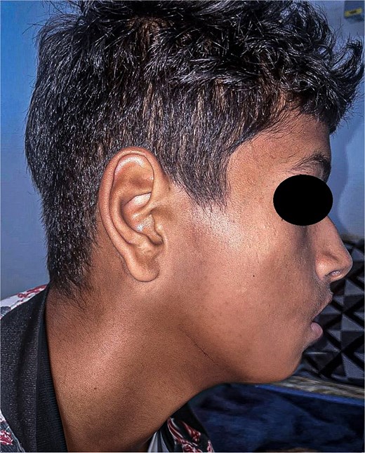 Postoperative photograph of the patient at 1-year follow-up.