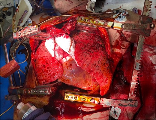 Clamshell thoracotomy in the ED for bilateral access to the thoracic cavity and mediastinum.