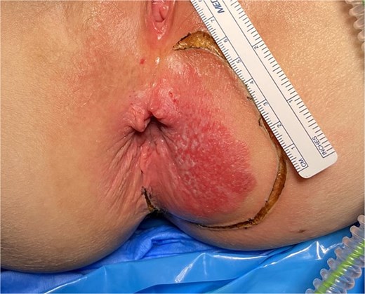 Perianal Paget’s disease prior to excision.