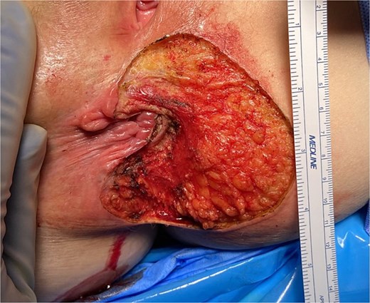 Perianal Paget’s disease after initial excision.