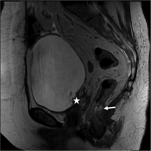 Rectal MRI, sagittal view. Star marks vaginal cuff mass with bladder invasion; arrow marks rectal tumor.