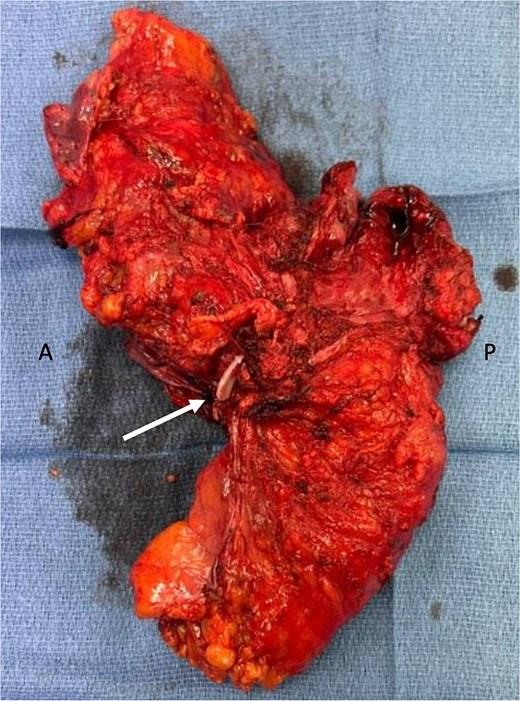 En-bloc resected specimen, right lateral view. Arrow indicates hemolok clip placed on ureter; letters A and P indicate anterior and posterior, respectively.